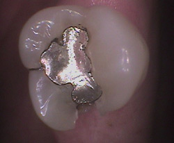 Broken Molar (Intra-oral Image)