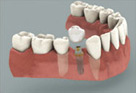 Implant With a Crown