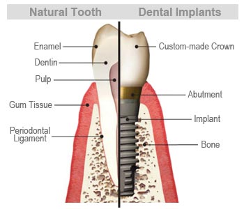 A Brief History of Dental Implants – Sutter Terrace Dental