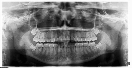 Panoramic X-ray (Adult)