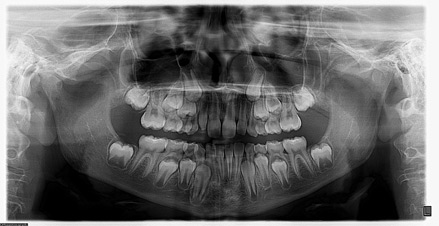 Panoramic X-ray (Child)